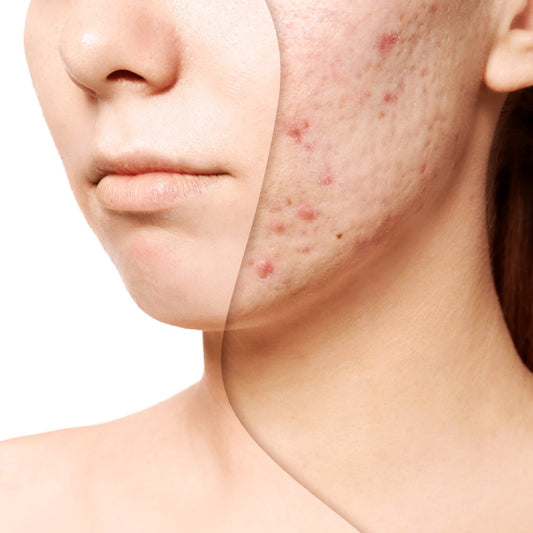 Acne facial