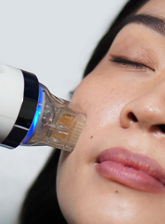Radiofrequency Microneedling