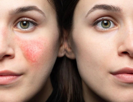 Rosacea Relief Facial